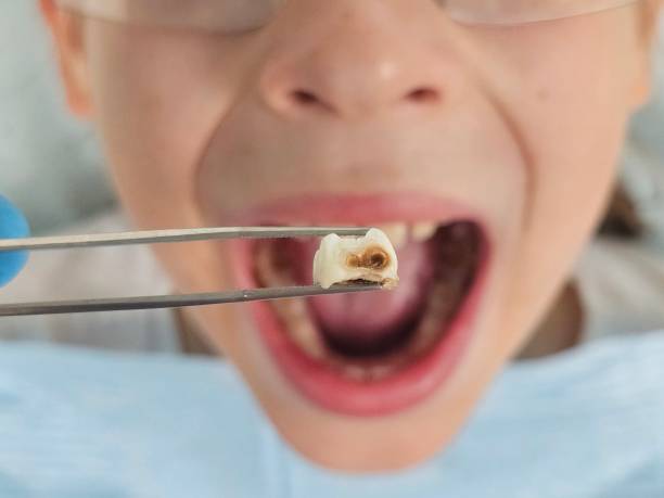 Best Emergency Dentist for Lost Fillings or Crowns in Grandview, TX